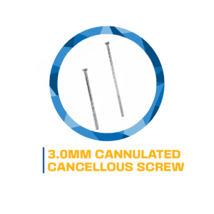 3.0mm cannulated cancellous screws.
